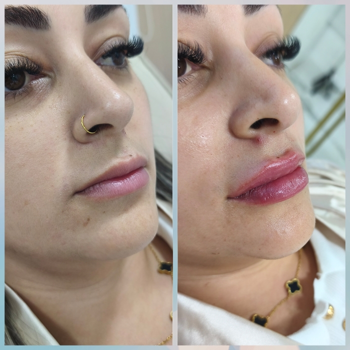 Antes e depois Preenchimento Labial Joana Cardoso