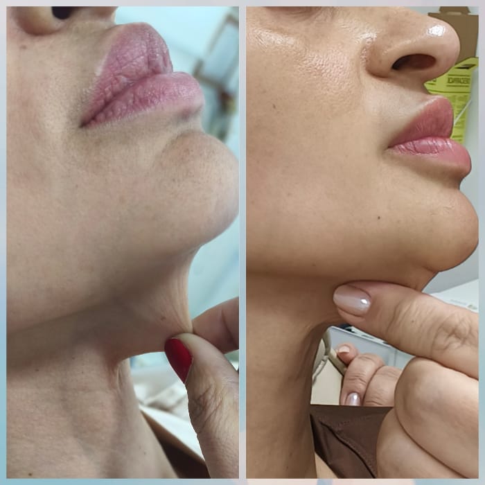 Antes e depois Ultrassom Microfocado Joana Cardoso