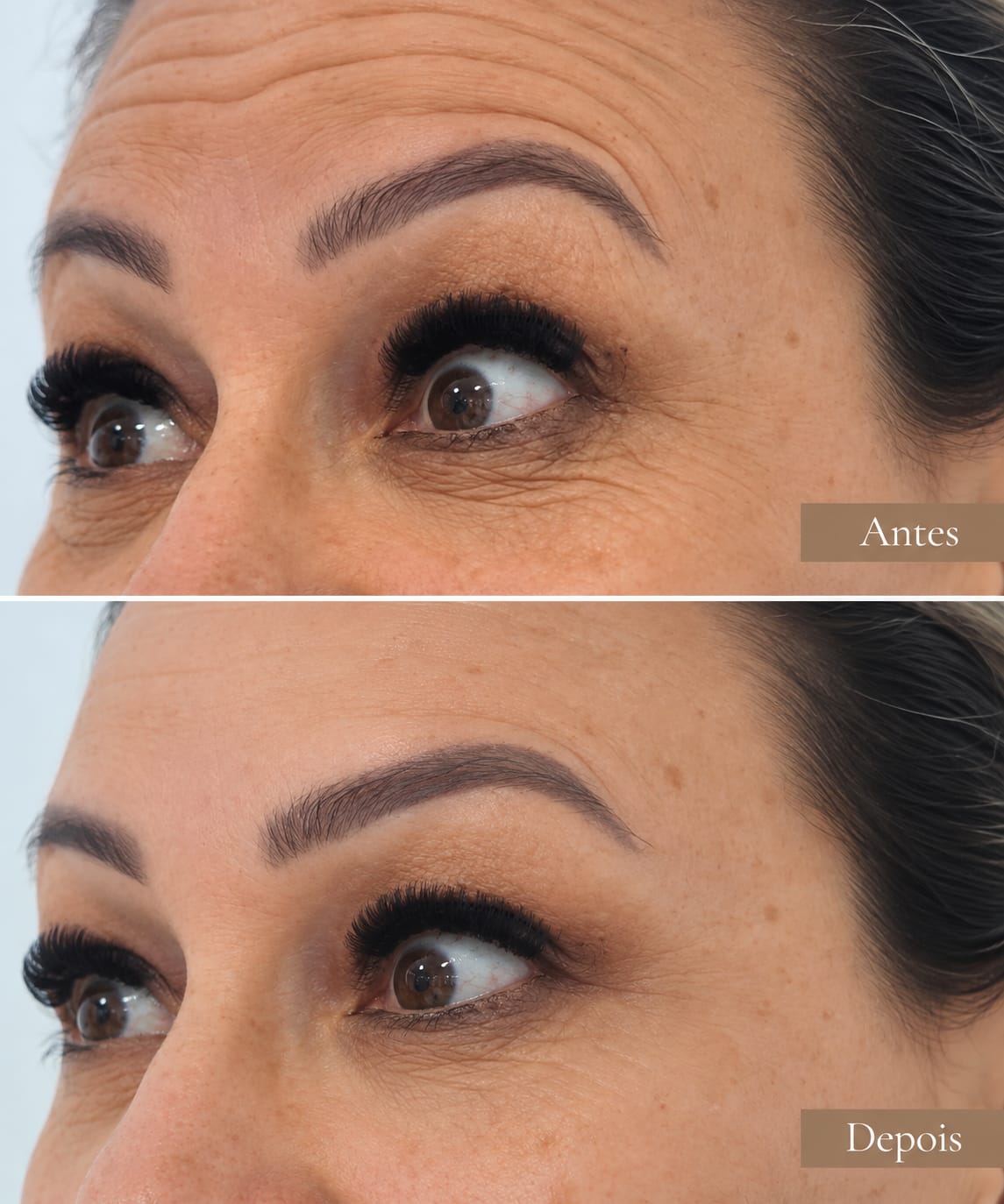 Rejuvenescimento da Área dos Olhos Joana Cardoso
