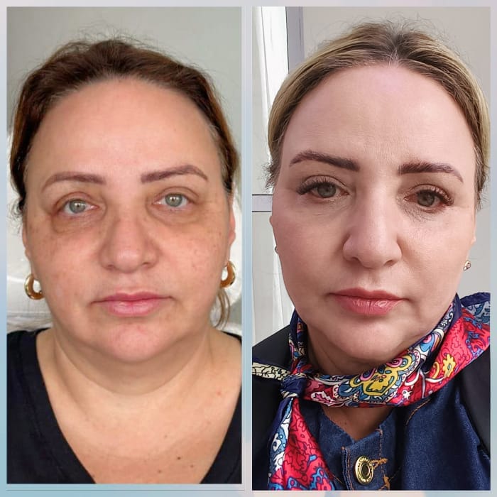 Antes e depois Rejuvenescimento Joana Cardoso