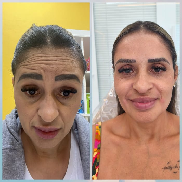 Antes e depois Linhas de Expressão Joana Cardoso