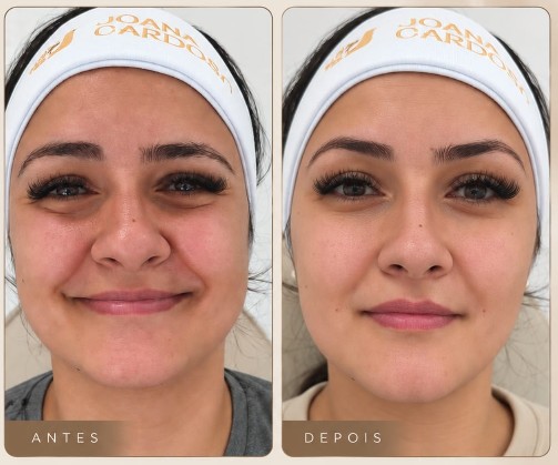 Harmonização Facial Real na Estética Joana Cardoso