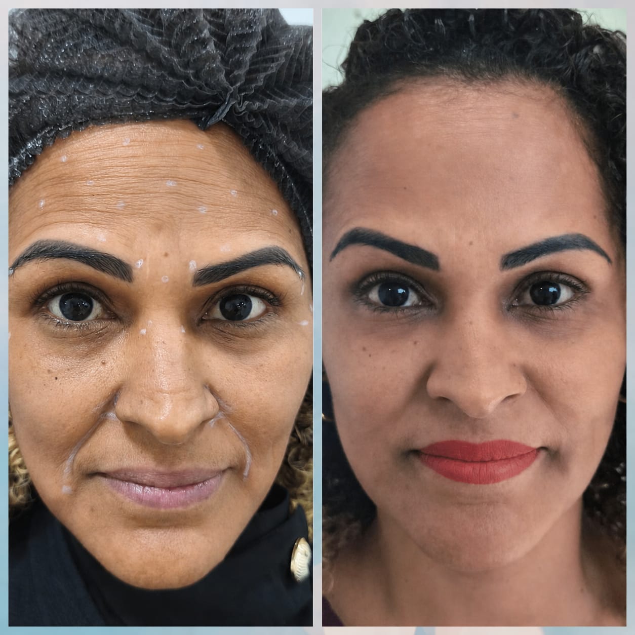 Planejamento de Harmonização Facial Joana Cardoso